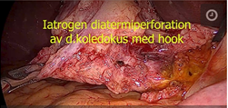 Iatrogen_diatermiperforation_med_hook_av_d.jpeg