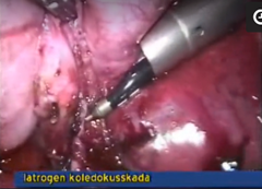 Iatrogen_koledokusskada_kort_o_bred_cysticus.jpeg