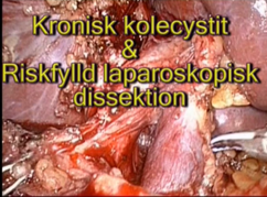 Kronisk_kolecystit_riskfylld_dissektion_portan_frilagd.jpeg