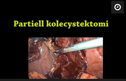 Partiell_kolecystektomi.jpeg