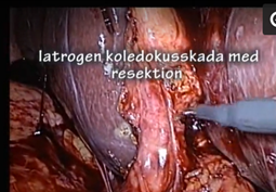 Partiell_koledokusresektion.jpeg