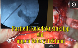 Partiellt_inklipp_i_koledokus_vid_oppen_kolecystektomi.jpeg