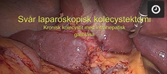 Svar_laparoskopisk_kolecystektomi_med_risk_for_skada.jpeg